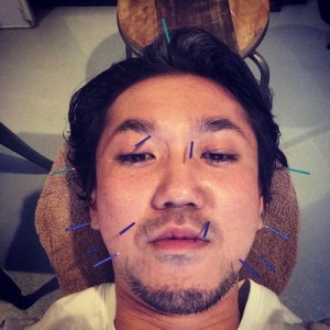 美容鍼灸ってやったことありますか？