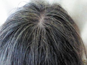 【QandA】白髪が多いと薄毛にならないって本当ですか？